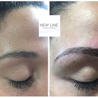 microblading de cejas -New Line Clínica Estética