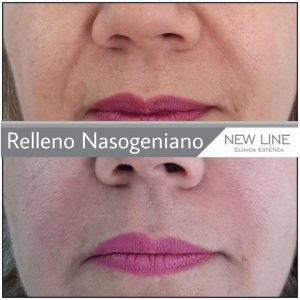 relleno surco nasogeniano con ácido hialurónico mujer new line clínica estética