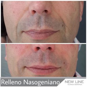 relleno surco nasogeniano con ácido hialurónico hombre new line clínica estética